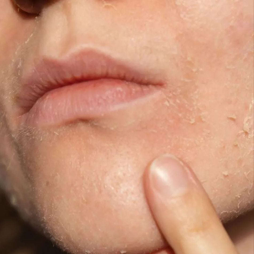 Dehydration + Dryness