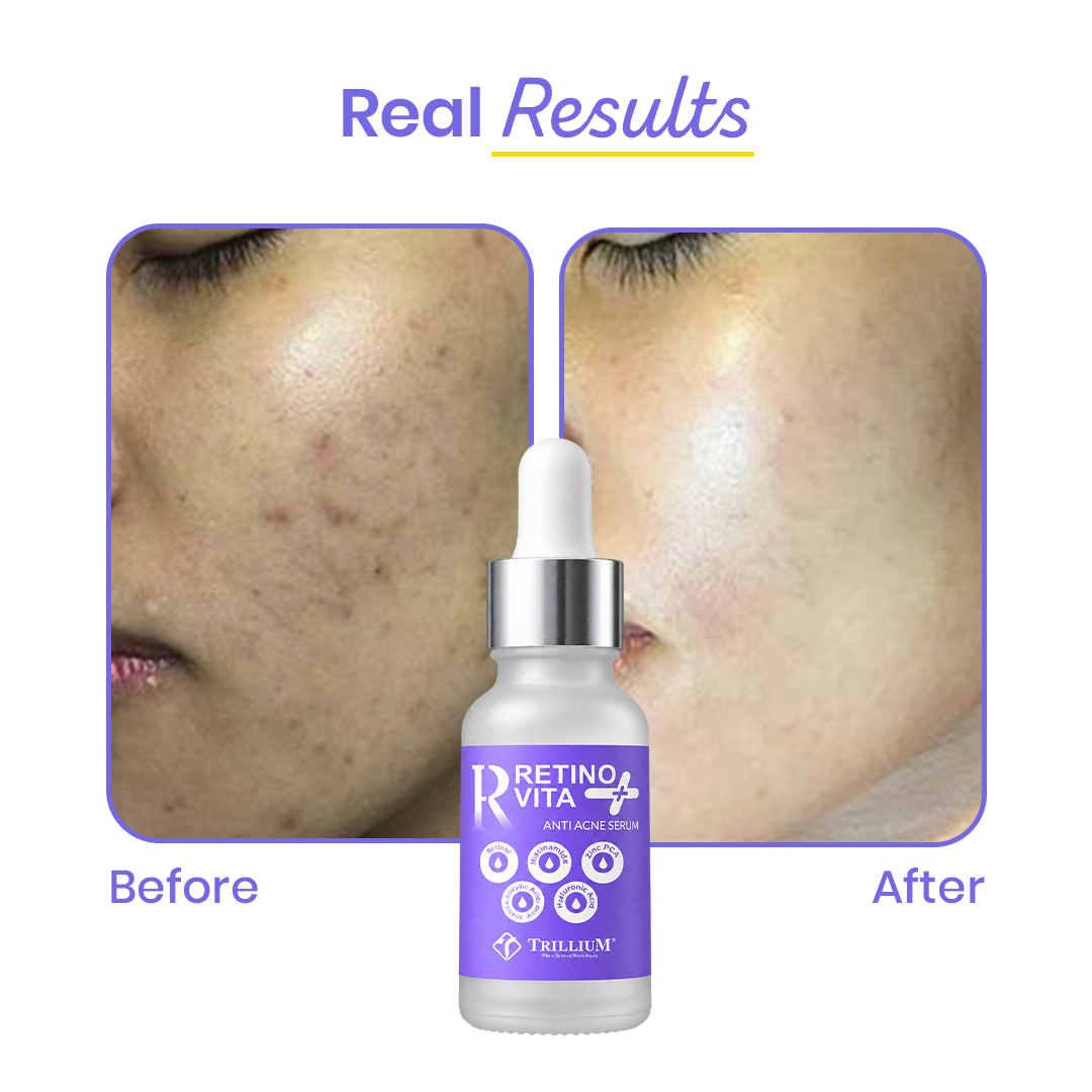 RetinoVita + Anti Acne Serum