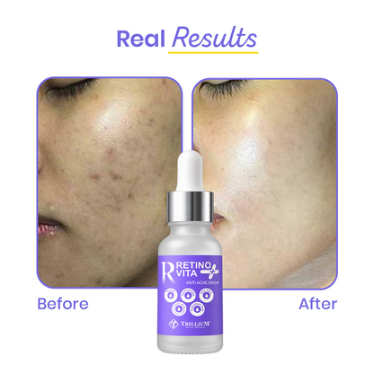 RetinoVita + Anti Acne Serum