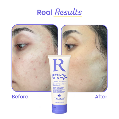 RetinoVita+ Clarifying Acne Facewash